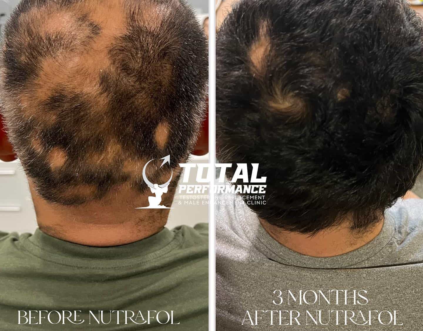 Hair Restoration VS Hair Transplant  Hair Loss Treatments